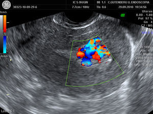 Los hallazgos ecográficos suelen consistir en la presencia de una masa ecogénica intrauterina hipervascularizada.