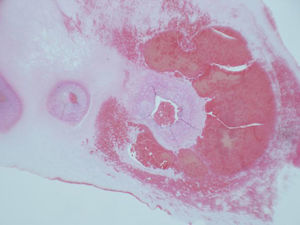 Imagen microscópica del hematoma de cordón umbilical.