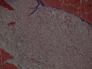 Imagen microscópica en la que se aprecia funiculitis del cordón umbilical.
