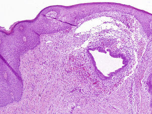 Tinción con hematoxilina. Glándulas y células endometriales en el seno de un tejido dérmico.
