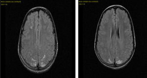 RM inicial: hiperintensidad de señales corticales y probablemente meníngeas en las regiones frontal, parietal y occipital, parcheada, parasagital, bilateral y simétrica, con predominio en el territorio posterior, sin restricción de la difusión.