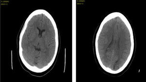 TC inicial: hipodensidad de la sustancia blanca occipital bilateral y parietal posterior derecha, compatible con edema vasogénico.