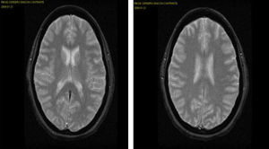 RM control (8.° día): áreas residuales de edema vasogénico en las regiones occipital y parietal.