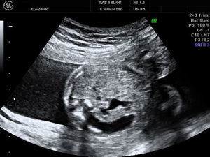 Riñón derecho, 24 semanas. Imagen en semiluna del urinoma rodeando la cápsula renal.