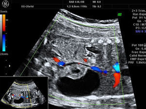 Riñón derecho, 25 semanas. Efecto masa con desplazamiento del riñón y la vena cava inferior hacia la línea media.