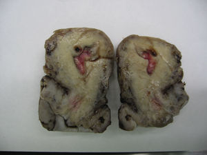 Corte longitudinal del útero. Se visualiza el defecto en la cara posterior del cérvix.