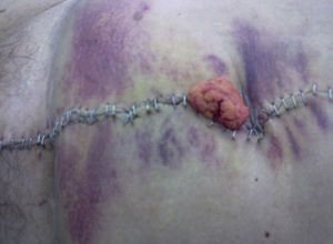 Complicación posquirúrgica. Evisceración a través de sutura abdominal.