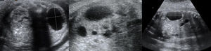 Hidronefrosis izquierda a las 27,5 SG con colección líquida de 40×50×30mm retroperitoneal izquierda perirrenal, con distorsión de la morfología del riñón desplazado medialmente compatible con urinoma.