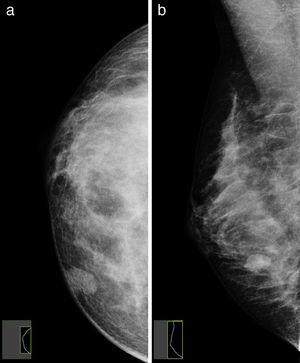 a y b) Mamografía craneocaudal y oblicua de la mama derecha: en la unión de cuadrantes internos-cuadrante inferointerno de la mama derecha se observa una pequeña lesión ovalada, con bordes circunscritos.
