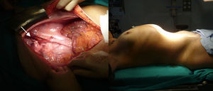 Cavidad abdominal tras ooforosalpingectomía derecha (flecha) y exéresis de la tumoración.