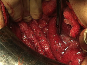 Siembra miliar intestinal.