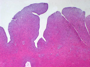 Morfología polipoide de la lesión (HE×40).