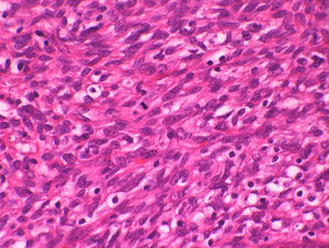 En el estroma se observan ocasionales figuras mitóticas, predominantemente en las zonas de los «collaretes». (HE×400).