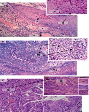 Descripción histológica de carcinoma escamocelular infiltrante. Casos representativos de carcinoma escamocelular (CE), que muestran las diferentes características estructurales y morfológicas de cada tipo histológico. A) CE bien diferenciado (BD) queratinizante (Q) de célula grande (CG), con áreas necróticas (AN). B) CE moderadamente diferenciado (MD) no queratinizante de célula grande (CG). CBE: células basales del epitelio que limitan con el estroma. C) CE pobremente diferenciado (PD) no queratinizante de célula grande (CG). E: infiltración epitelial al estroma.