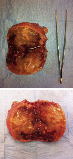 Aspecto macroscópico del tumor una vez resecado y abierto, mostrando tractos fibrosos y áreas de consistencia gelatinosa, junto con áreas de aspecto hemorrágico.