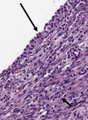 Imagen histológica del ovario izquierdo: zona de ovario donde se aprecia parte de la pared de un folículo quistificado (flecha grande) y la infiltración tumoral adyacente (flecha pequeña).