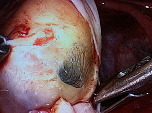 Laparoscopia donde se objetiva teratoma ovárico con presencia de tejido graso y faneras.