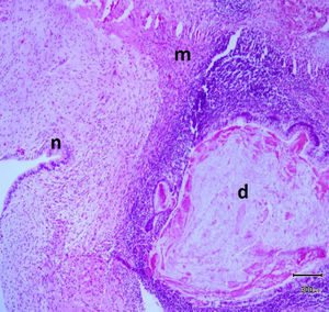 Estudio histopatológico. Áreas de tumor que contiene tejido nervioso (n), músculo liso (m) y tejido digestivo (d), en la misma sección.