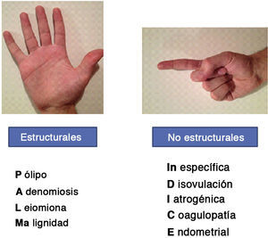 Clasificación de la causa del sangrado uterino anómalo no relacionado con la gestación propuesta por la FIGO. Causas del sangrado menstrual prolongado y/o abundante.