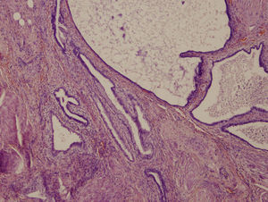 Mullerianosis vesical (H-E x 40). Estructuras glandulares rodeadas de tejido fibroso, sin reconocerse estroma de tipo endometrial entre las mismas.