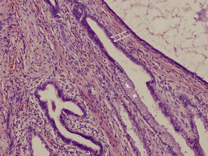 Mullerianosis vesical (H-E x 100). A mayor aumento en una misma glándula se observa tanto epitelio cilíndrico ciliado de tipo tubárico (flechas), como cilíndrico endocervical (asteriscos).