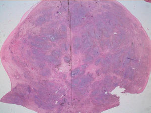 Metástasis ovárica de cáncer de mama.