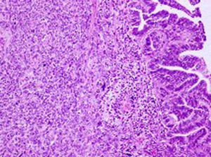 Neoplásica bifásica compuesta por áreas de adenocarcinoma íntimamente entremezcladas con áreas mesenquimales fusocelulares malignas. HE ×100.