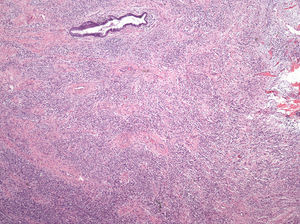 Adenosarcoma mülleriano de cérvix. Aumento 2x. La figura muestra tejido conjuntivo ocupado por una proliferación de aspecto mesenquimatoso que se agrupa en haces y que abarca la presencia de una glándula endocervical.