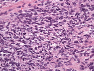 Adenosarcoma mülleriano de cuello de útero. Aumento ×40. La imagen muestra atipia celular y actividad mitótica.