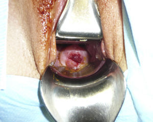 Exploración clínica poscirugía: tumor residual de 1cm, a partir del labio posterior de cérvix uterino.