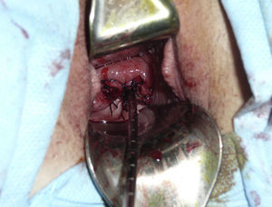 Tratamiento conservador del adenosarcoma mülleriano de cérvix. La imagen muestra el cérvix de la paciente tras la realización de una conización extensa.