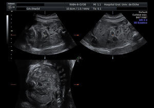 La imagen ecográfica muestra una calcificación intraabdominal difusa.