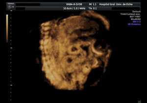 Imagen ecográfica en 3D. Muestra dilatación de asas intestinales y calcificaciones intraabdominales difusas, sospechoso de peritonitis meconial.