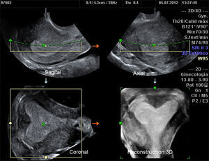 Útero arcuato que podría confundirse con un subsepto. Contorno externo recto o con mínima concavidad menor de 10mm y cavidad no triangular con escotadura con ángulo central >90° (obtuso).