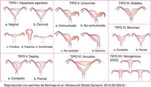 Clasificación de las malformaciones uterinas según la American Fertility Society (1988).