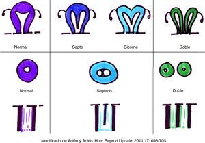 Clasificación anatómica VCUAM. De arriba abajo, útero, cérvix y vagina con las diferentes posibilidades de combinación de malformaciones.