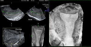 Ajuste de la ventana de renderización que permite fácil y rápidamente obtener la imagen 3D para realizar la valoración de la cavidad y el contorno uterino en un plano coronal. Útero normal: cavidad triangular recta y contorno convexo. La valoración se ha realizado en fase secretora.
