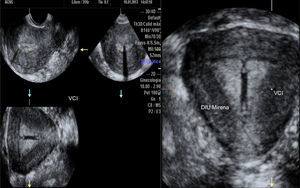 Volumen 3D con Volume Contrast Imaging (VCI), herramienta que mejora la resolución y facilita la valoración de la relación cavidad/contorno uterino, en una paciente portadora de un DIU Mirena. Plano inicial de adquisición medio sagital. Útero normal, cavidad triangular recta y contorno uterino convexo.