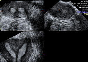 Útero septo con adquisición del volumen desde un plano axial. Pese a que en esta ocasión no había gran separación entre los cuernos, mejoró la valoración de la relación cavidad/contorno externo. Exploración realizada en fase secretora y sin buena imagen del cuello, por lo que sería recomendable realizar el estudio en 2tiempos e incluso en fase periovulatoria, ya que el moco cervical mejora la valoración de la extensión del tabique y su distancia al orificio cervical externo.