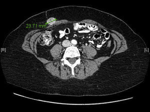 TC de control a los 12 meses poscirugía. Masa de 26×24mm en grasa subcutánea en la pared anterior del abdomen sobre el recto anterior derecho.