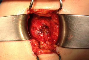Masa de 26×24mm en grasa subcutánea en la pared anterior del abdomen sobre el recto anterior derecho.