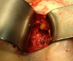 Lesión dudosa de 6mm evidenciada en la TC, que resultó ser un granuloma formado alrededor de un punto.