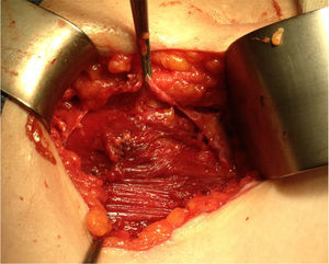 Defecto en la pared abdominal secundario a resección de los nódulos tumorales.