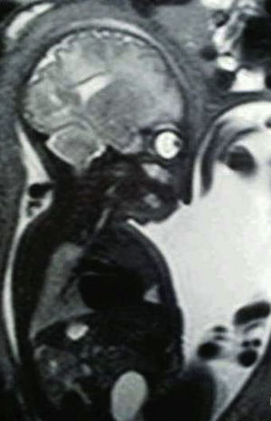 Resonancia magnética fetal intraútero. Útero septo. Feto en presentación de nalgas. Corte coronal.