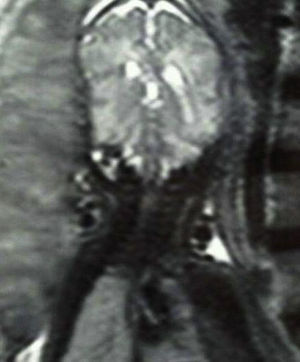 Resonancia magnética fetal intraútero centrada en cabeza fetal. Cabeza fetal atrapada entre placenta y columna vertebral materna.