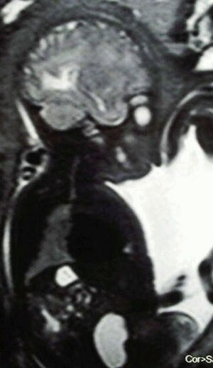 Resonancia magnética fetal intraútero. Línea media facial fetal en contacto con septo uterino.