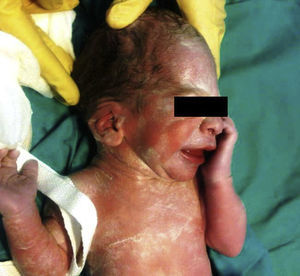 Recién nacido tras parto, se visualiza oreja de implantación baja así como hundimiento del hueso parietal de ese lado.