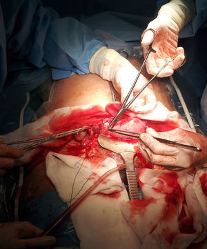 Sutura de la base implantación del cuerno uterino rudimentario derecho tras su exéresis.