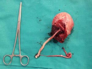 Cuerno uterino rudimentario derecho con placenta inserta y con rotura en fondo.