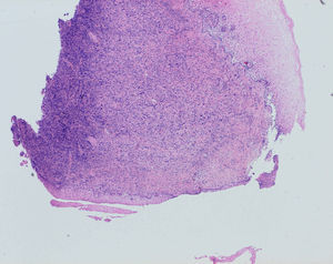 Tumoración pélvica heterogénea en cérvix de 7,5×5cm, sin signos de afectación ganglionar.